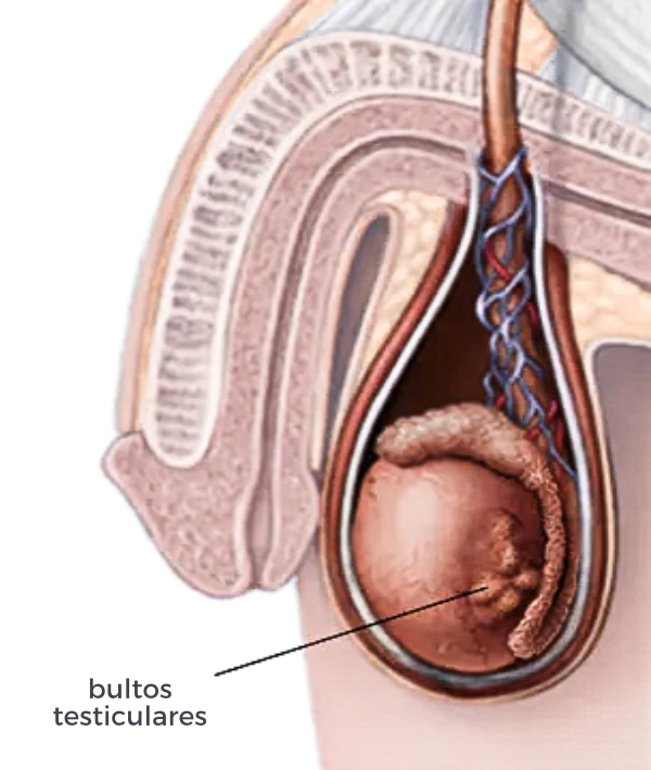 cáncer de testiculo